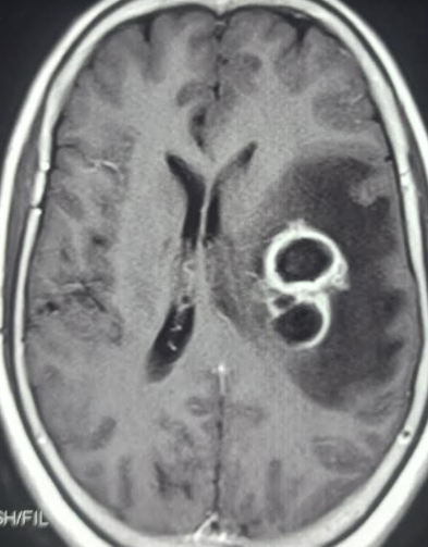 <p>Brain Abscess.</p>