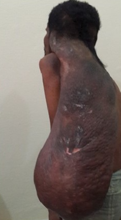 <p>Solitary Giant Neurofibroma</p>