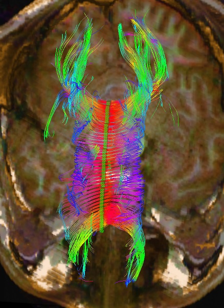 DTI of corpus callosum