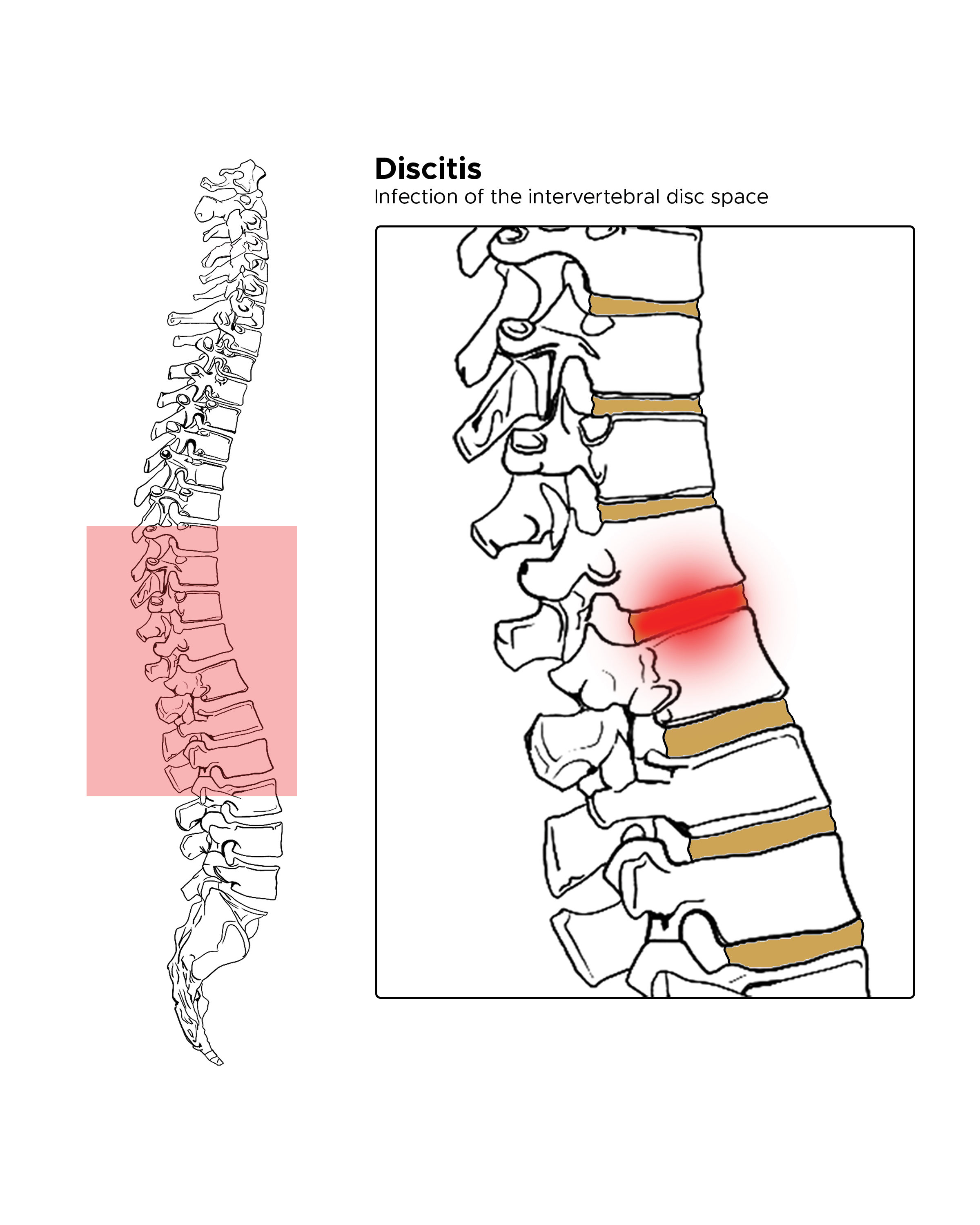 <p>Discitis. The illustration shows inflamed intervertebral disc space or discitis.</p>