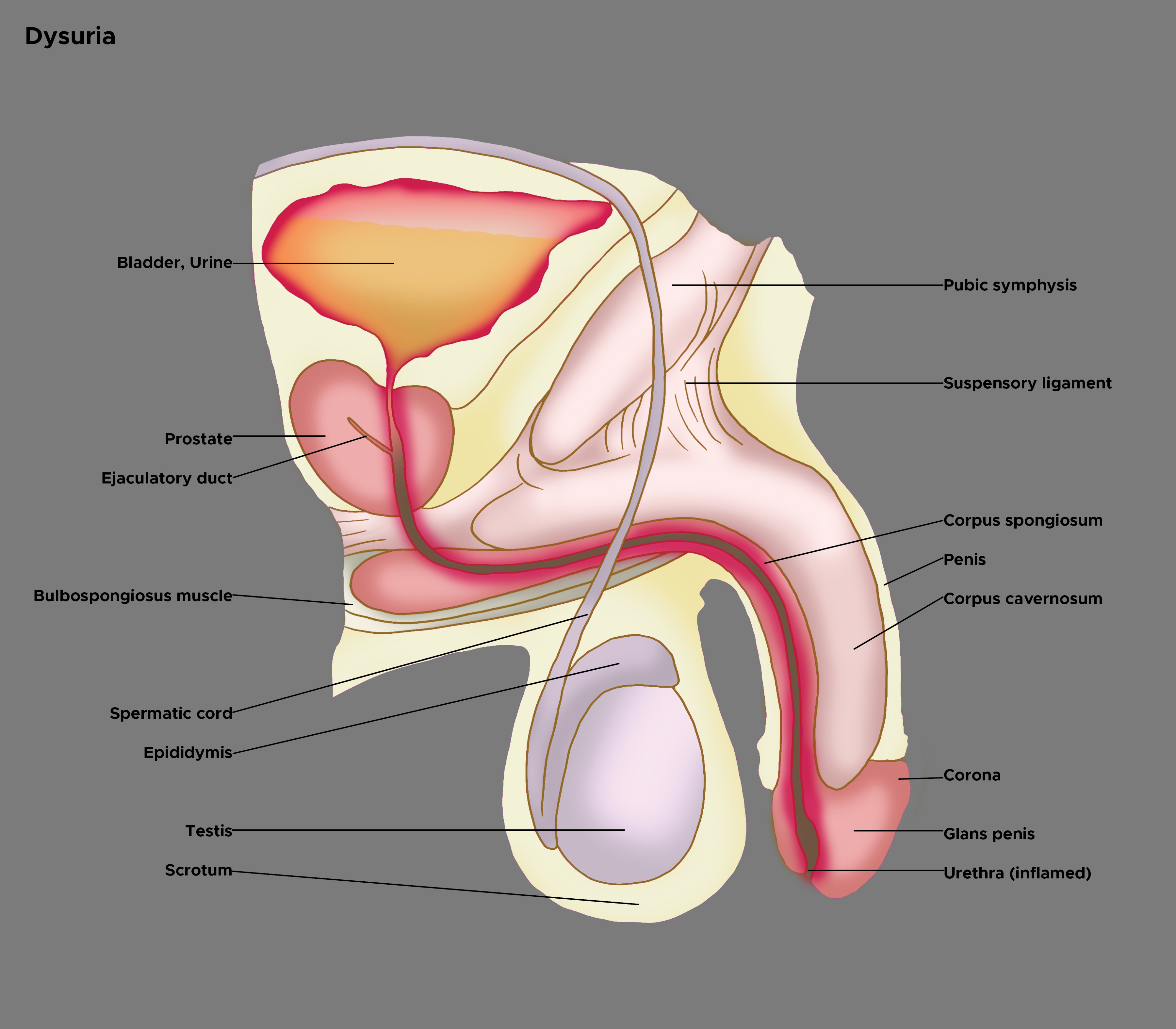 Illustration of dysuria