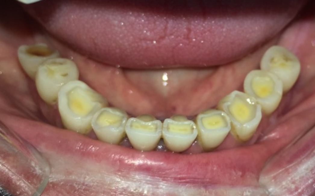 Tooth surface loss in mandibular teeth. Attrition is the main etiological factor. Erosion is likely to be also involved.