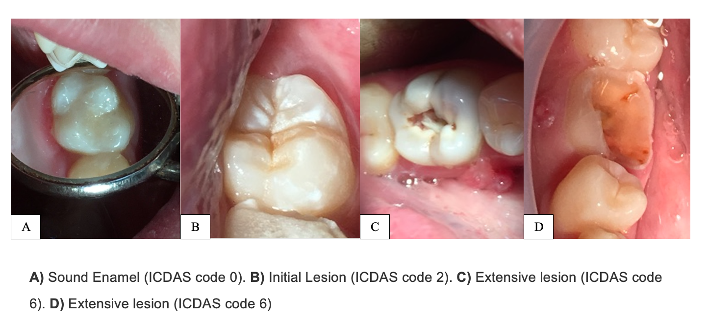 Examples of ICDAS codes.