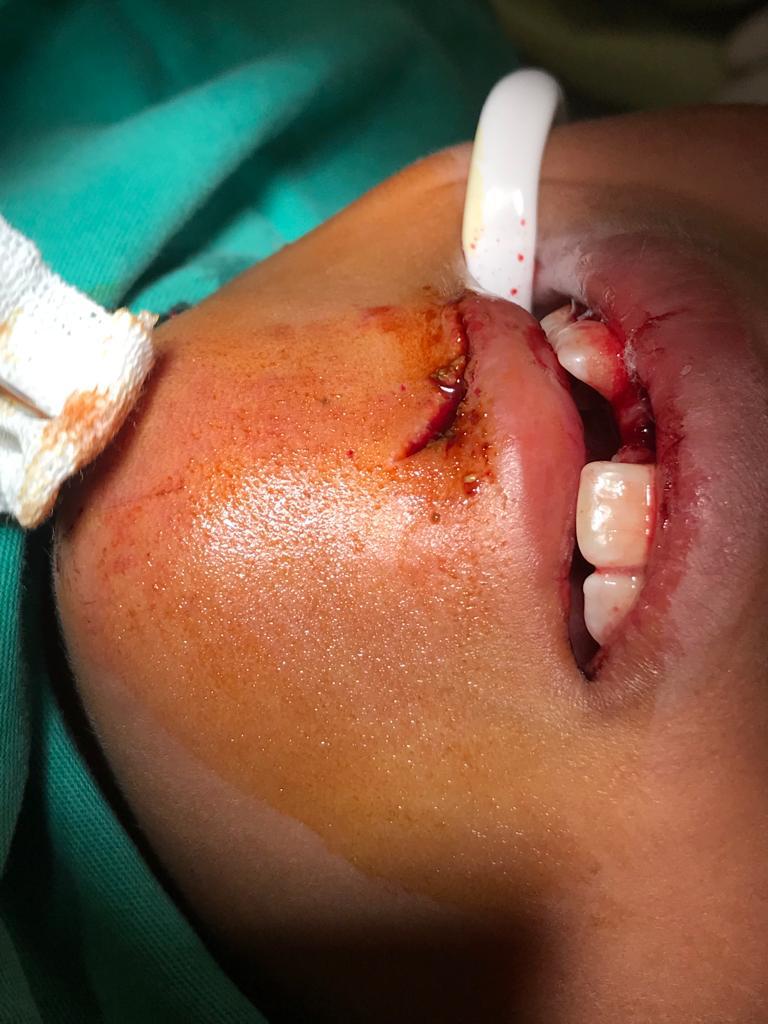 <p>Skin Laceration of Lower Lip and Chin After Trauma. The 11 was avulsed.</p>