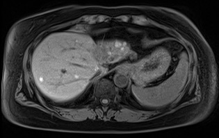 <p>Metastatic Ocular Melanoma. The image depicts metastatic ocular melanoma lesions in the liver.</p>