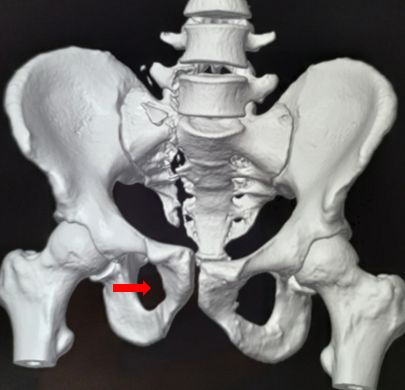 <p>Obturator Foramen
