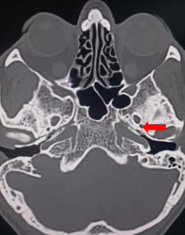 Foramen spinosum