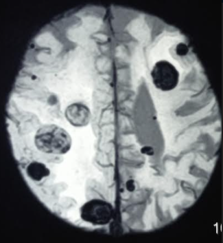 <p>Multiple Hemorrhagic Metastases to the Brain</p>