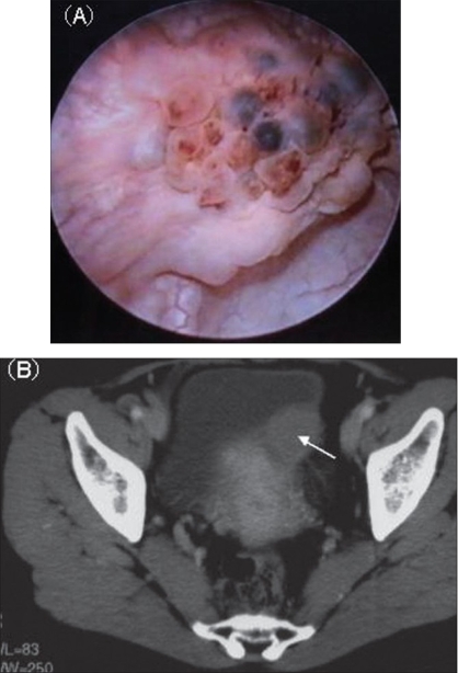 <p>Cystoscopy of Bladder Tumor