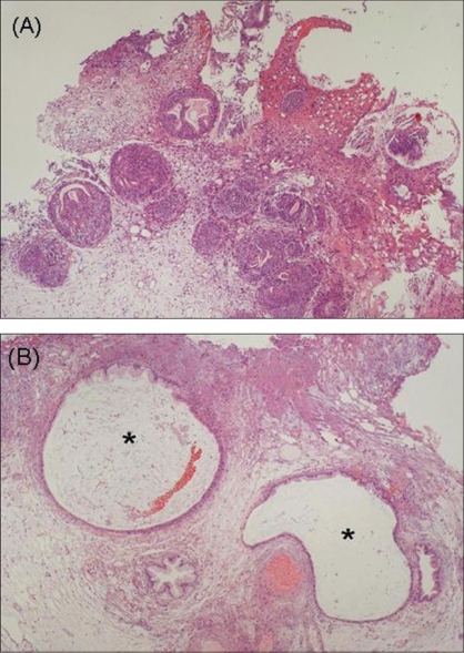 <p>A Histopathological Examination of Cystitis Cystica and Cystitis Glandularis