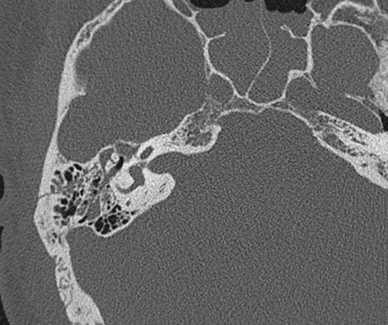 <p>Right Temporal Bone Fracture Observed on CT Scan
