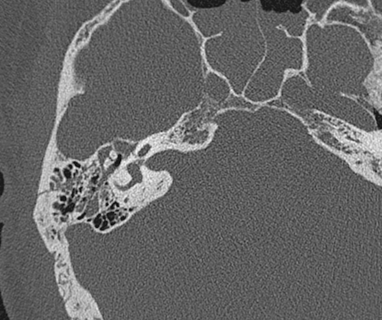 <p>Right Temporal Bone Fracture Computed Tomography