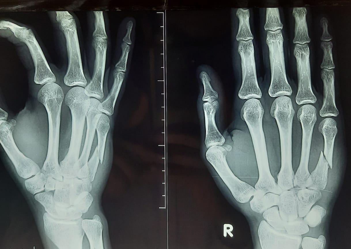 Metacarpal Shaft Fracture