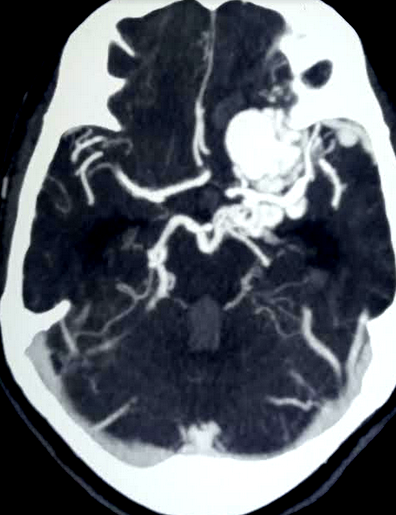 Intracranial AVM