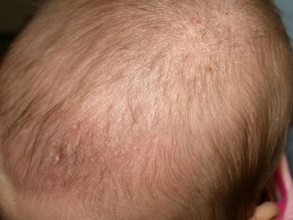 <p>Cradle Cap</p>