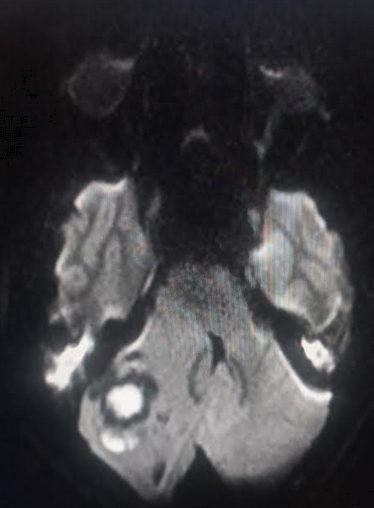 <p>Cerebellar Abscess