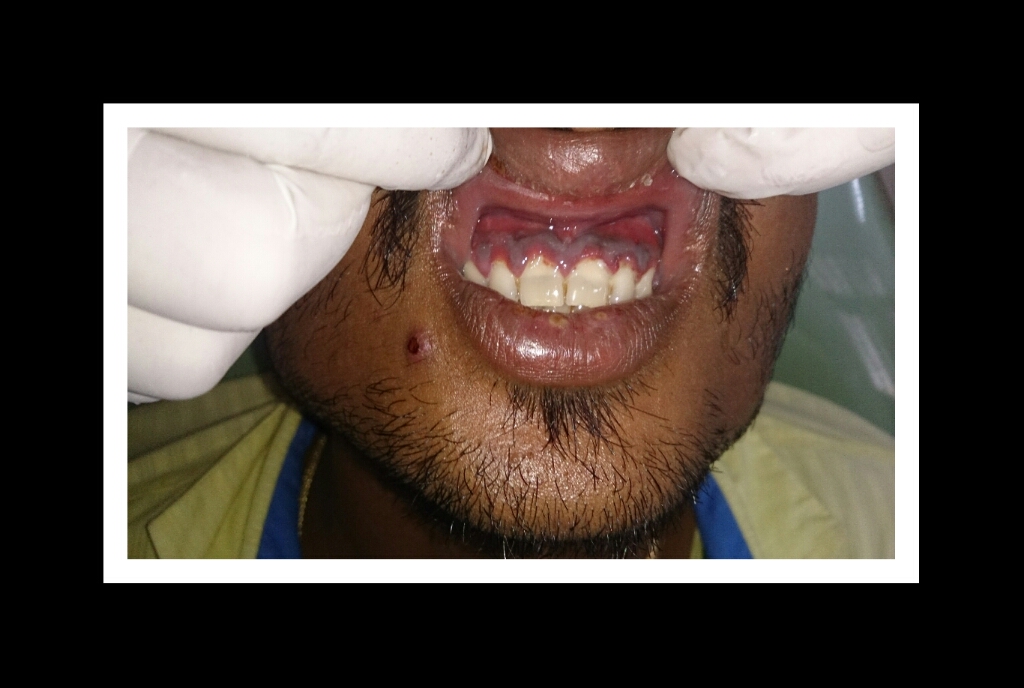 <p>Necrotizing Gingivitis with Pseudomembrane Formation