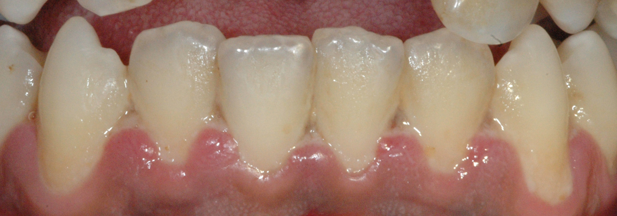 Necrotizing gingivitis. Presence of pseudomembrane and loss of interdental papillae.