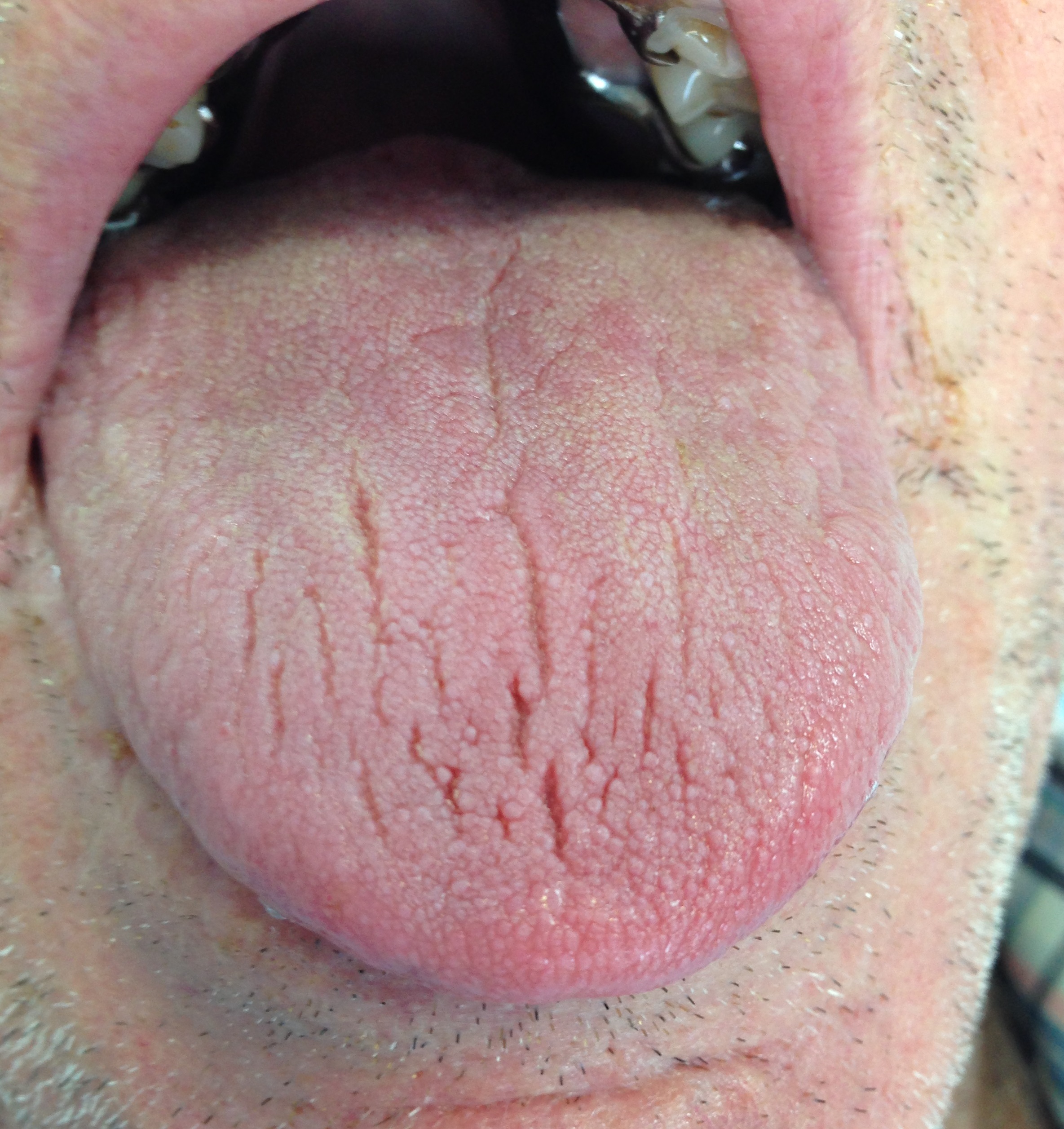 <p>Xerostomia. This is an image of a patient with xerostomia (dry mouth). Note the fissures on the dorsum of the tongue.</p>