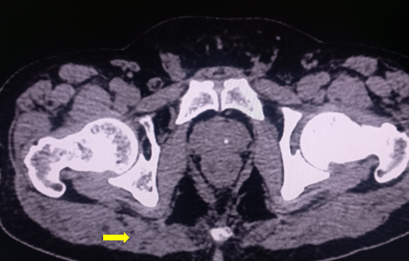 <p>Gluteus Maximus.</p>