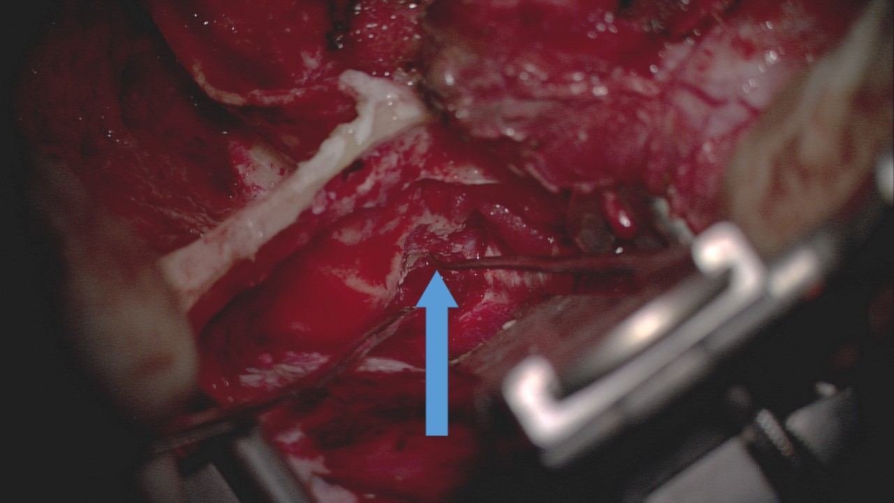 <p>Middle Fossa Craniotomy Approach for Facial Nerve Decompression