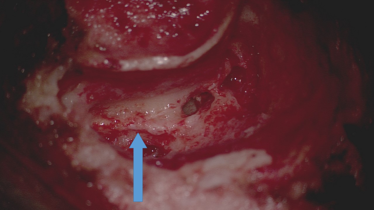 <p>Transmastoid Facial Nerve Decompression. The facial nerve is indicated by the blue arrow.</p>