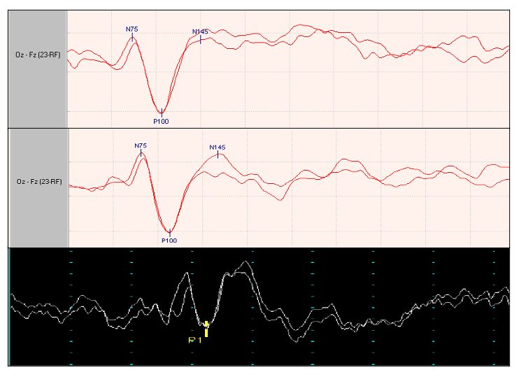 Pattern and flash visual evoked potentials (VEPs) results.