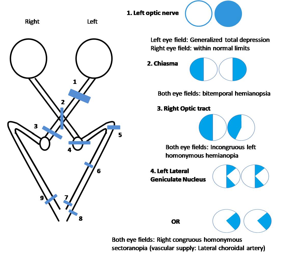 Field defects due to disorders in visual pathway