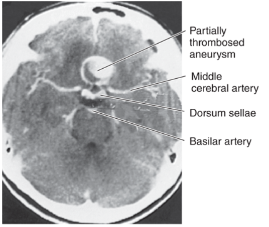 Computed tomography image of a horizontal section through the head, showing a large aneurysm of the anterior communicating artery