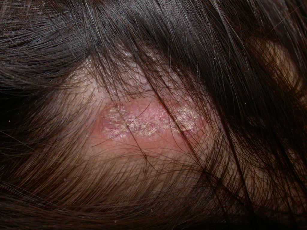 <p>Discoid Lupus, Scalp</p>