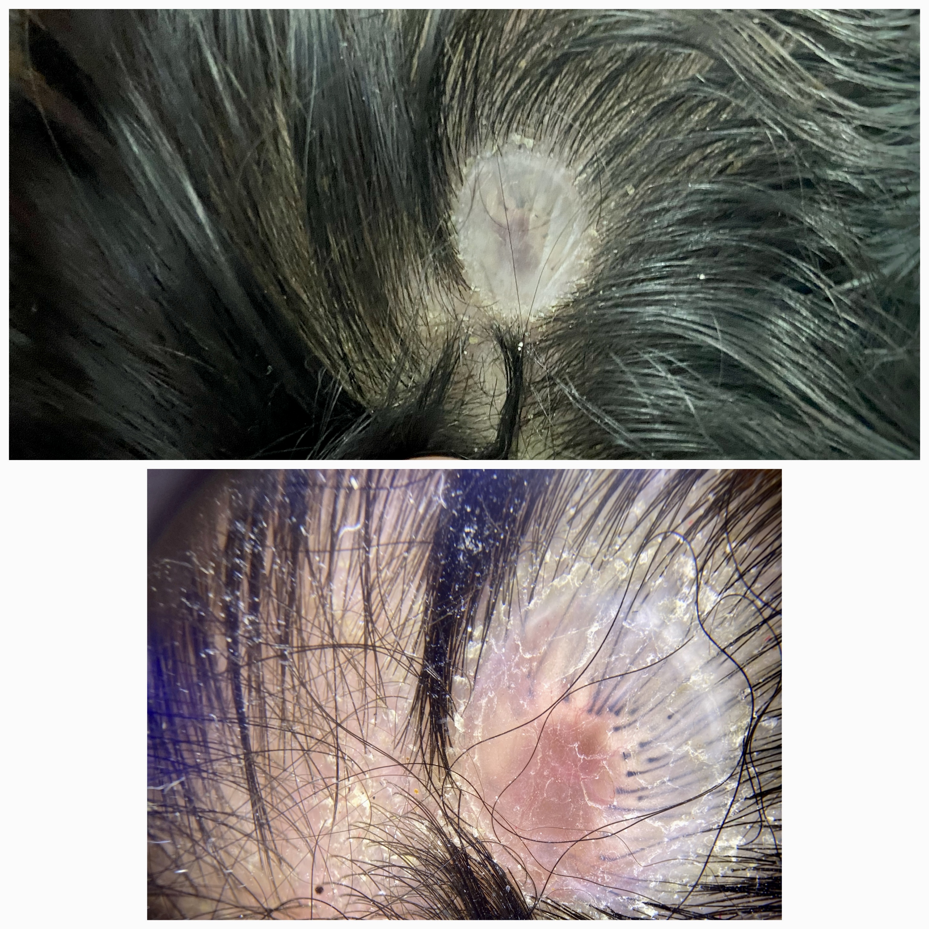 <p>Dermoscopy&nbsp;Findings in Membranous Aplasia Cutis Congenita