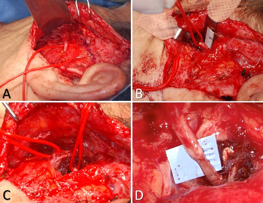 <p>Masseteric Nerve Transfer