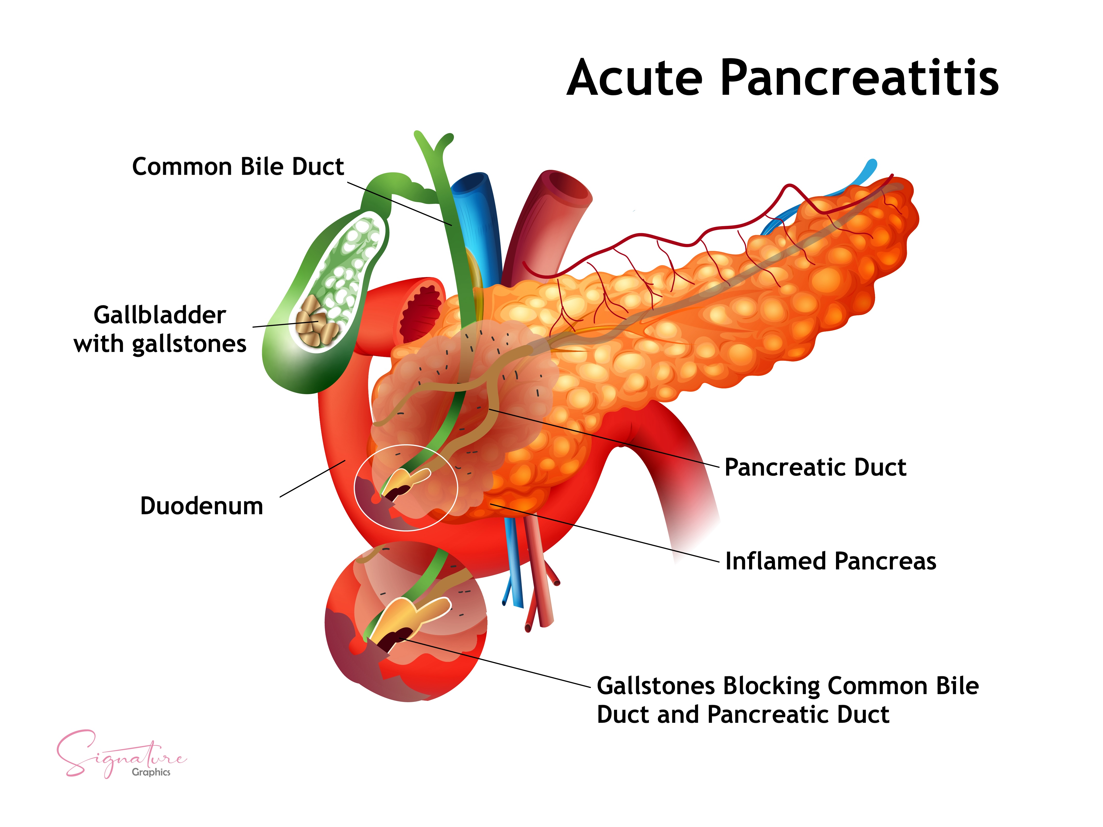 <p>Acute Pancreatitis,&nbsp;Gallstones. This is a graphic illustration of acute pancreatitis caused by gallstones.</p>