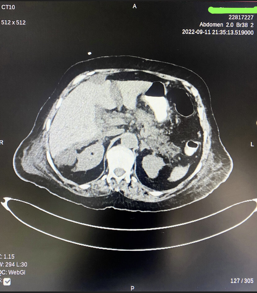 <p>Necrotising Pancreatitis&nbsp;With&nbsp;Extensive Peripancreatic Nodularity