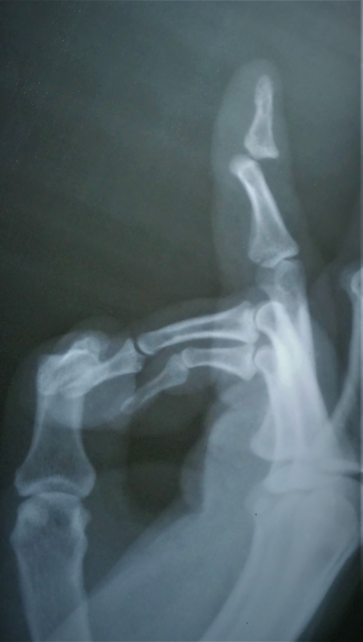 <p>Distal Interphalangeal (DIP) Joint Dorsal Dislocation, Radiograph