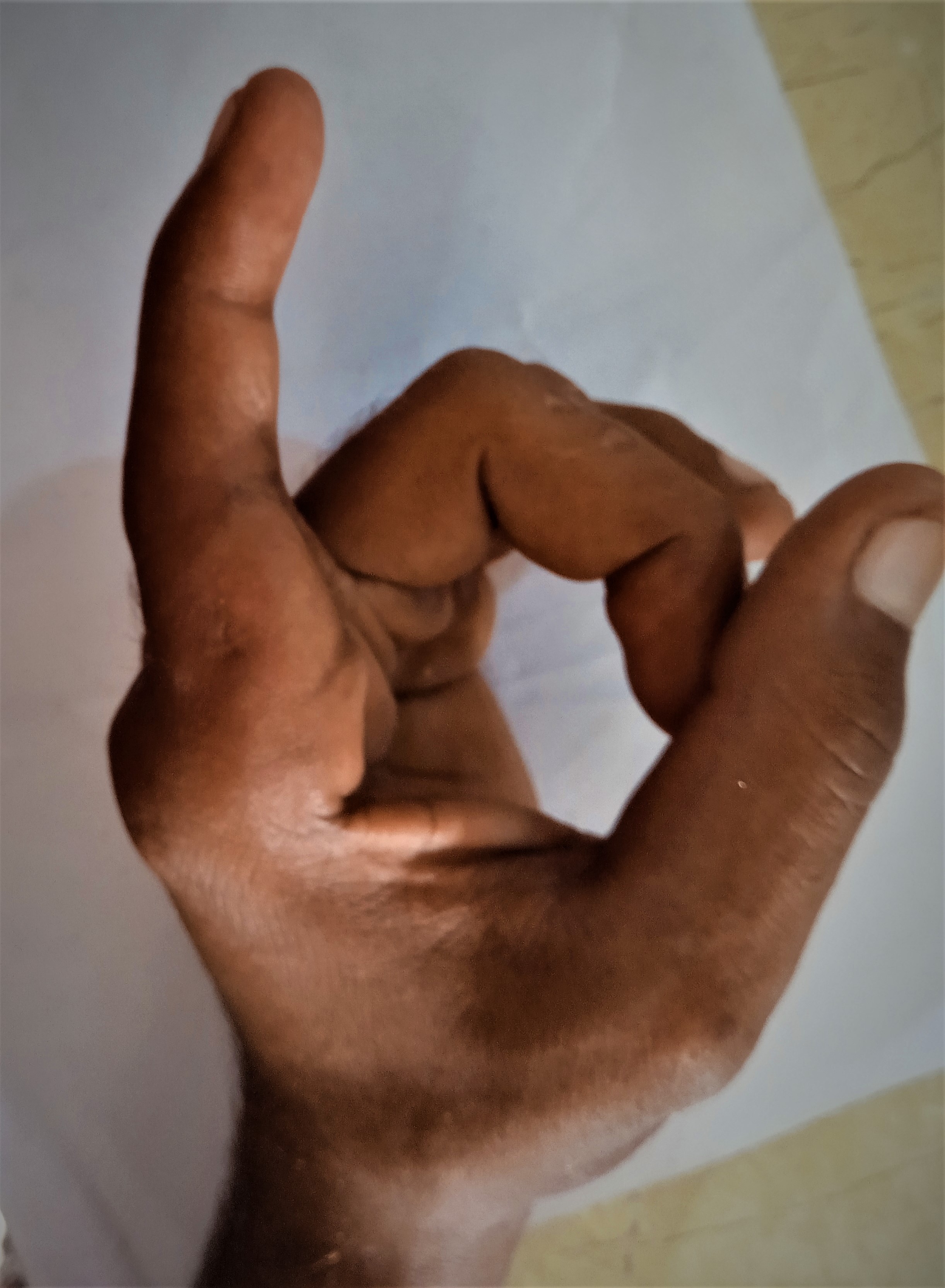 <p>First&nbsp;Metacarpophalangeal Joint Dorsal Dislocation