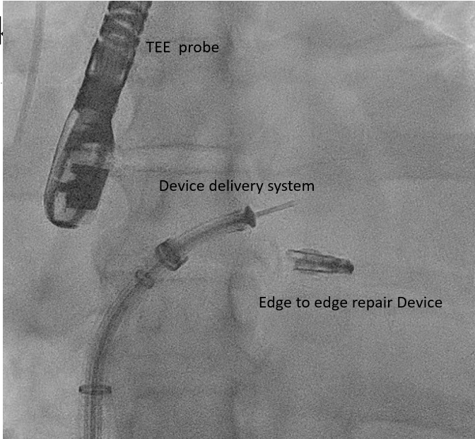 <p>Transcatheter Edge-to-Edge Valve Repair Device