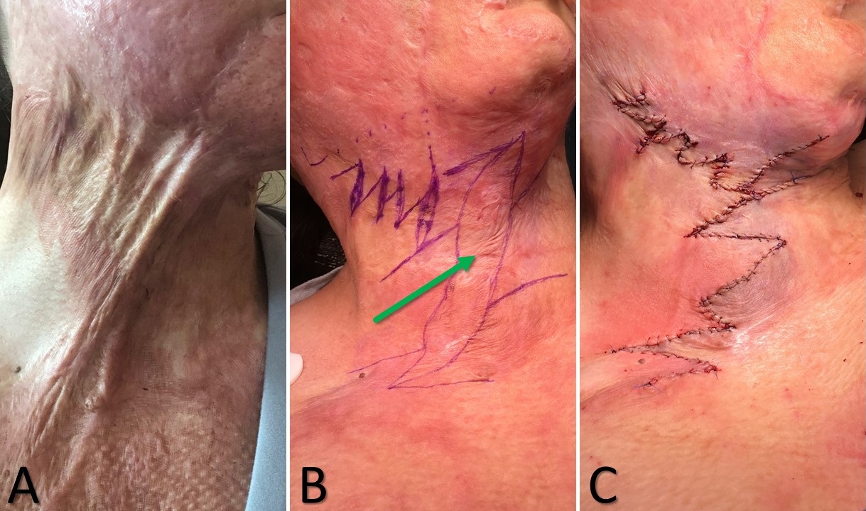 <p>Running Z-Plasty Technique for Burn Scar Contracture Release