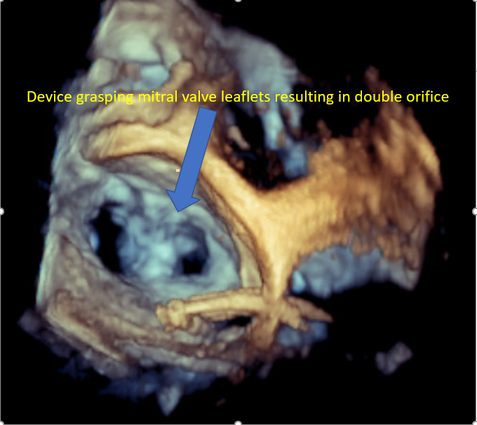 <p>Mitral Valve Repair, Edge-to-Edge Percutaneous Device