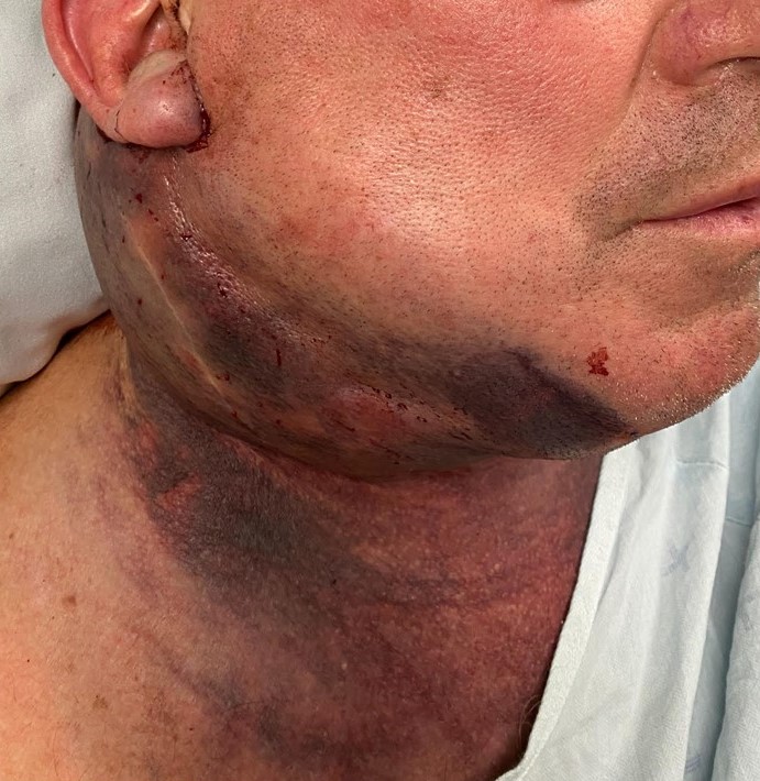 <p>Upper Neck Hematoma