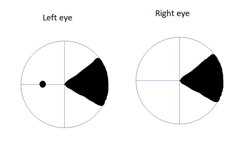 Schematic diagram of right wedge-shaped homonymous sectoranopia due to the damage of lateral posterior choroidal artery