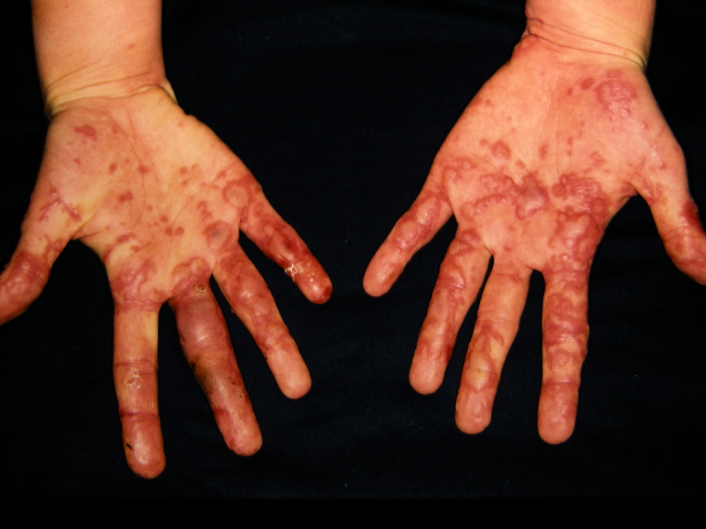 <p>Erythema Multiforme.&nbsp;Image showing the typical target lesion of the erythema multiforme.</p>