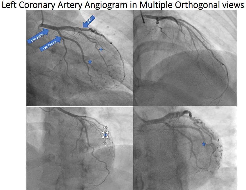 <p>Left Coronary Angiogram, Various Orthogonal Views