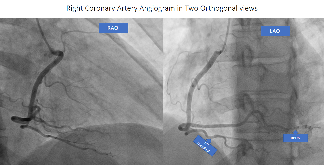 <p>Right Coronary Angiogram, Two Orthogonal Views. RAO: right anterior oblique. LAO: left anterior oblique.</p>