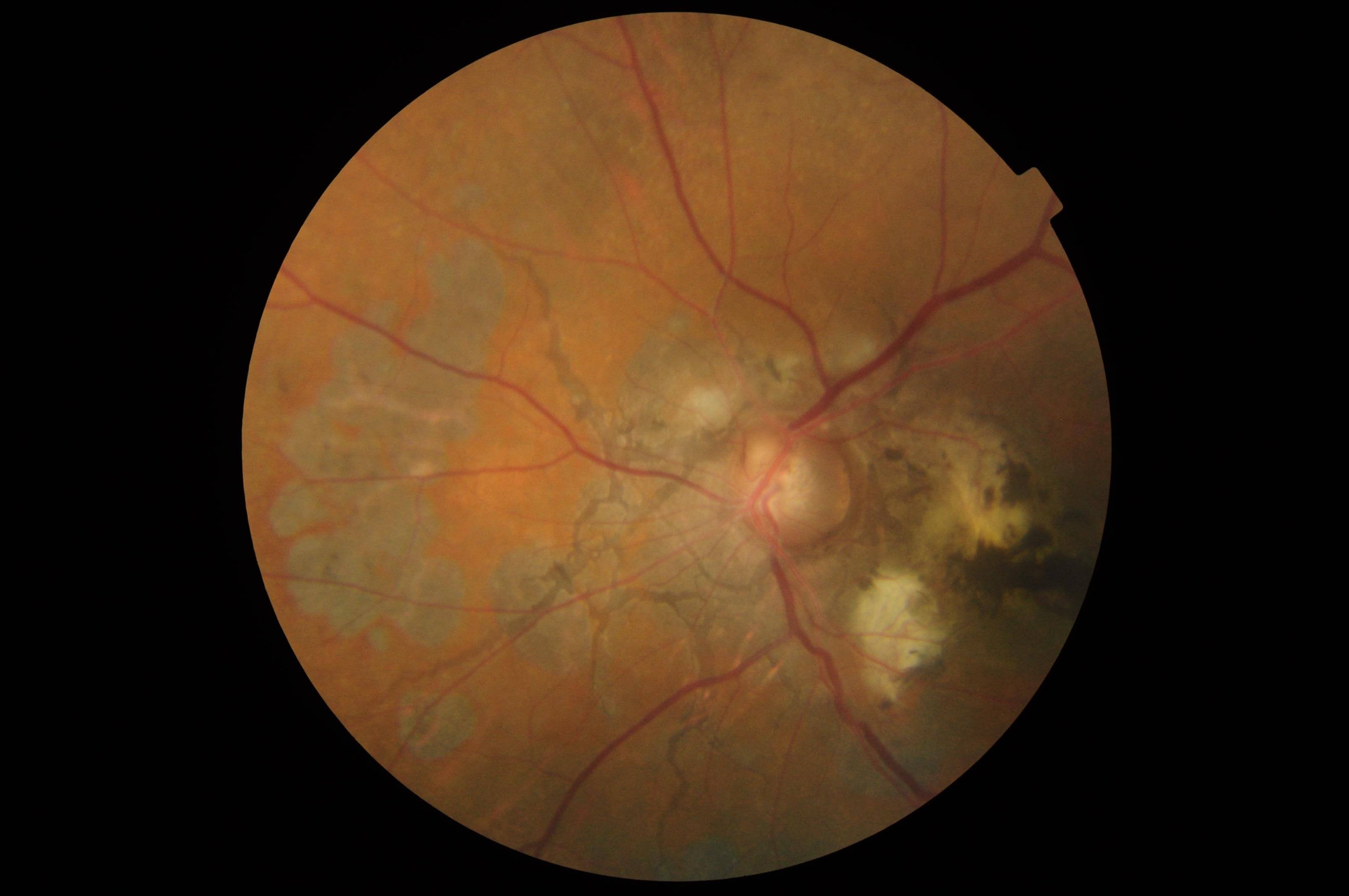 <p>Choroidal Neovascularization