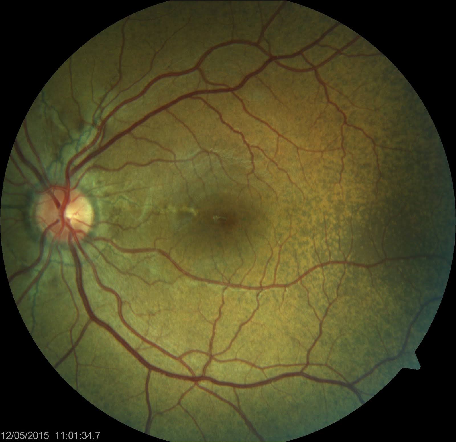 <p>Angioid Streaks and Peau d'Orange of Fundus