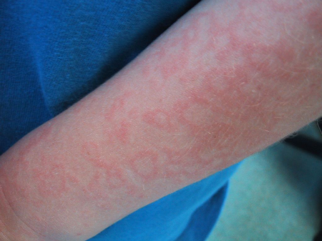 <p>Fifth Disease, Arm</p>