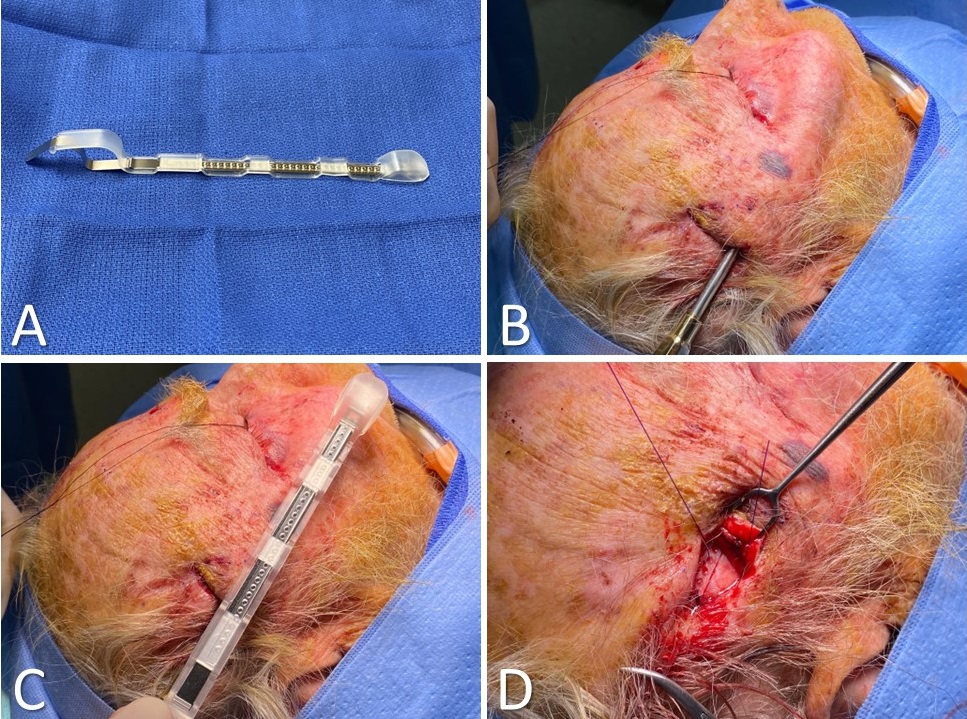 <p>Midface Lift Using Resorbable Tine Prosthesis