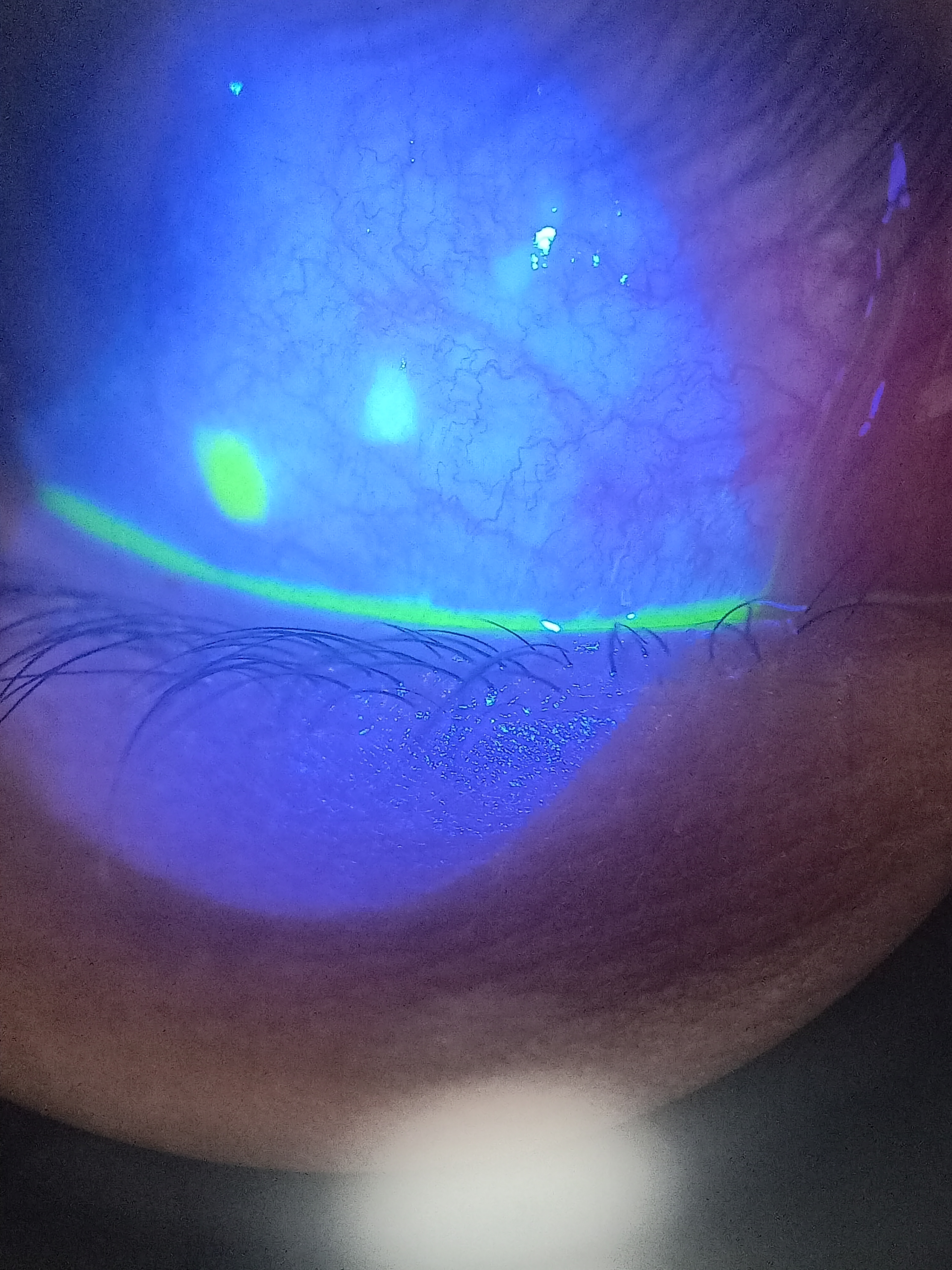 <p>Conjunctival Congestion