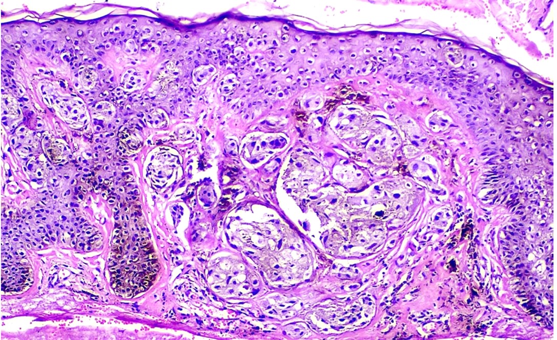 Superficial spreading melanoma in-situ with early invasion (H and EX100).